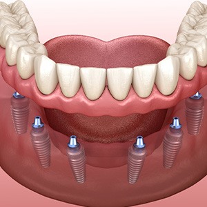 A CGI of an implant denture