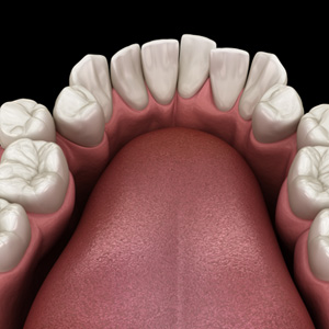 Illustration of crowded teeth