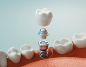 Dental implant. 